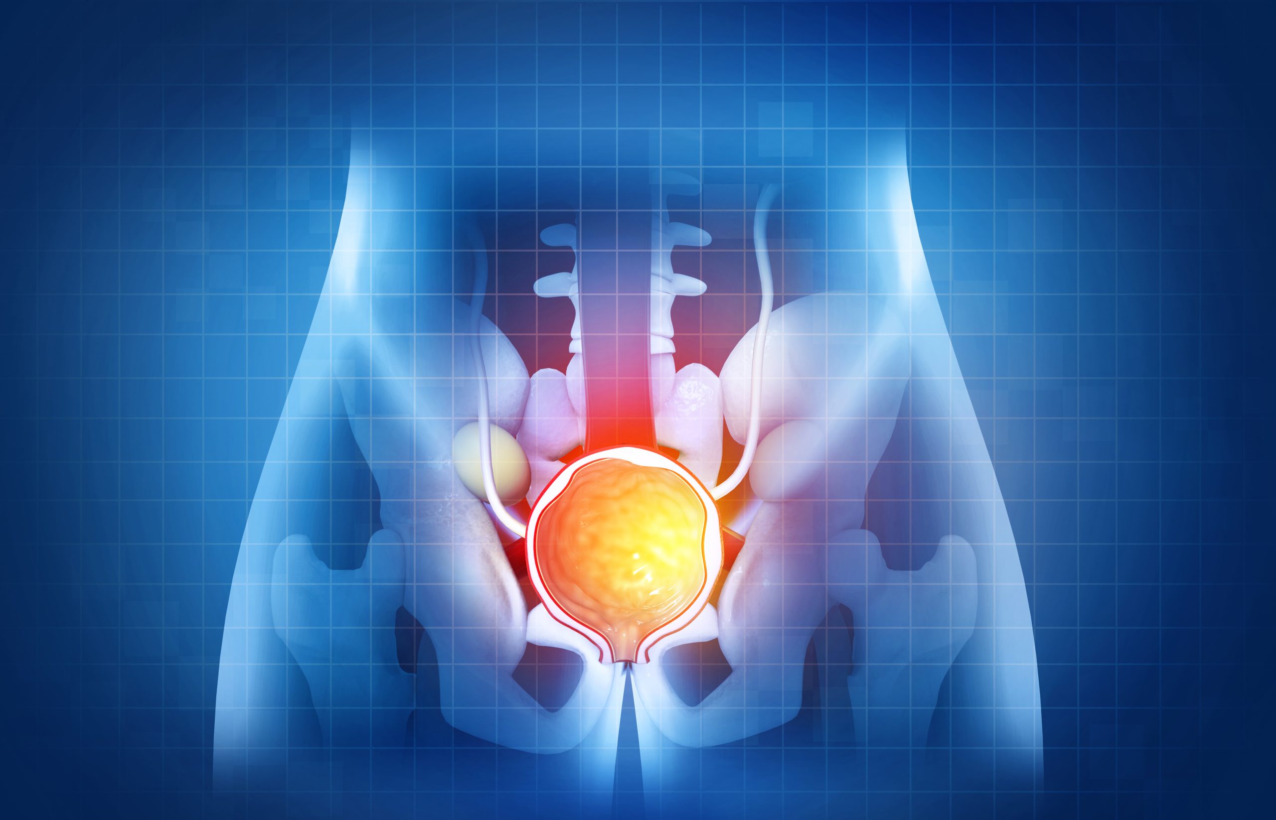 Prostate disease, Benign prostatic hyperplasia (BPH), Prostate cancer. 3d illustration Prostate disease, Benign prostatic hyperplasia (BPH), Prostate cancer. 3d illustration
